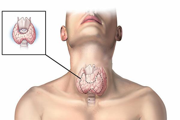 UNG THƯ TUYẾN GIÁP ĐANG CÓ XU HƯỚNG TRẺ HÓA