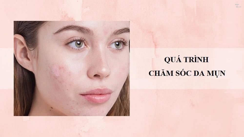 Quá trình chăm sóc da mụn hiệu quả nhất
