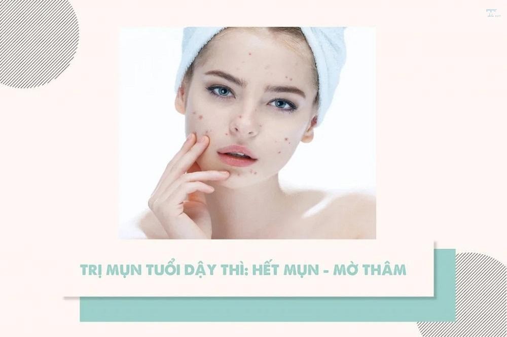 Kem trị mụn cho trẻ em: Cách chọn sử dụng hiệu quả