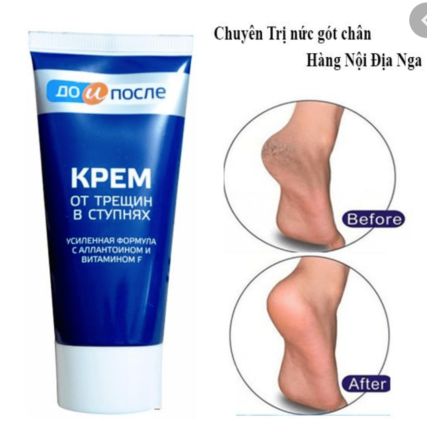 Kem Trị Nứt Gót Chân Nga Kpem