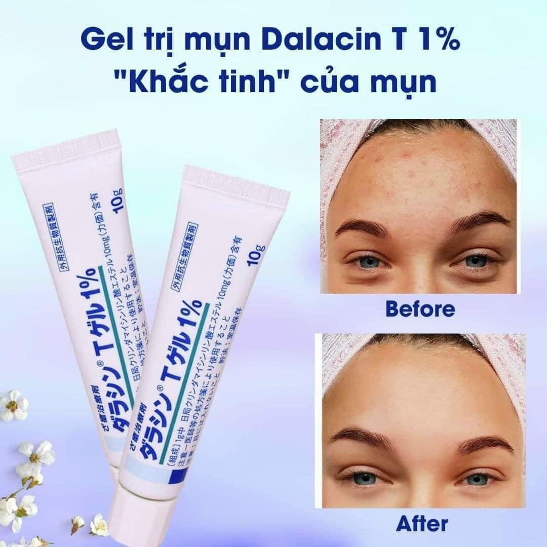 Kem trị mụn Dalacin T Gel 1% của Nhật