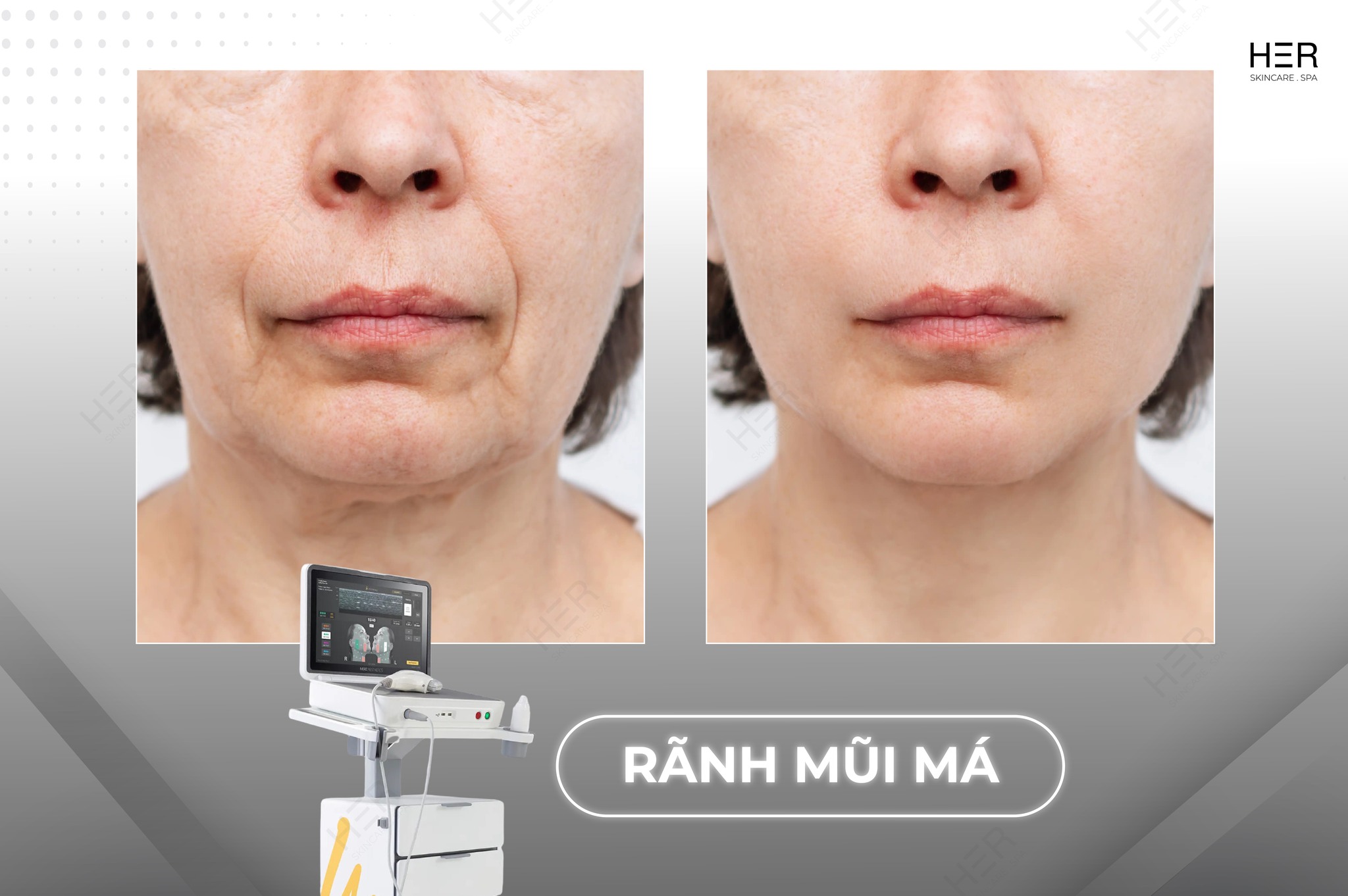 CONG-NGHE-ULTHERAPY-PRIME-THE-HE-MOI-NHAT-2025-TAI-HER-SKINCARE-amp-SPA-3.jpg