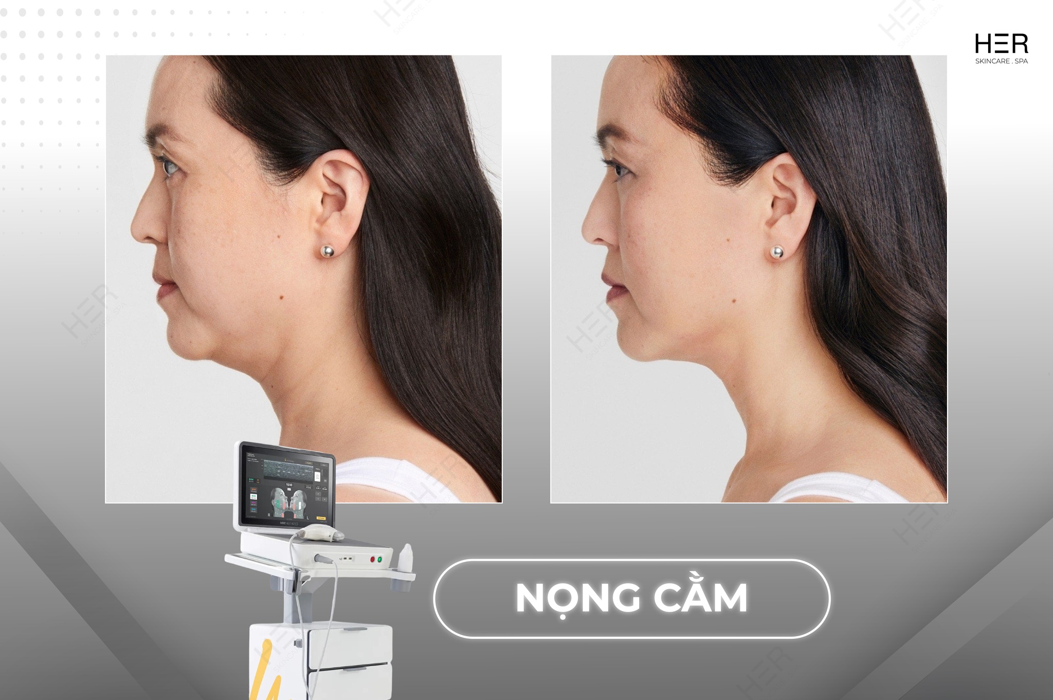 CONG-NGHE-ULTHERAPY-PRIME-THE-HE-MOI-NHAT-2025-TAI-HER-SKINCARE-amp-SPA-4.jpg
