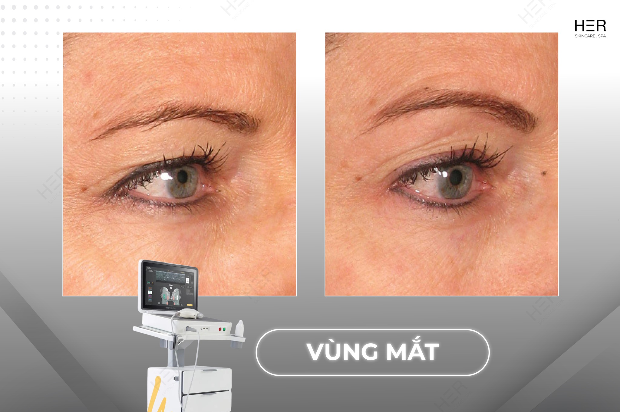 CONG-NGHE-ULTHERAPY-PRIME-THE-HE-MOI-NHAT-2025-TAI-HER-SKINCARE-amp-SPA-5.jpg