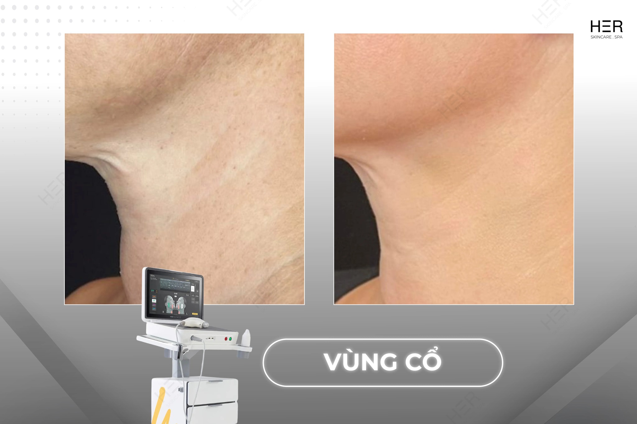 CONG-NGHE-ULTHERAPY-PRIME-THE-HE-MOI-NHAT-2025-TAI-HER-SKINCARE-amp-SPA-6.jpg