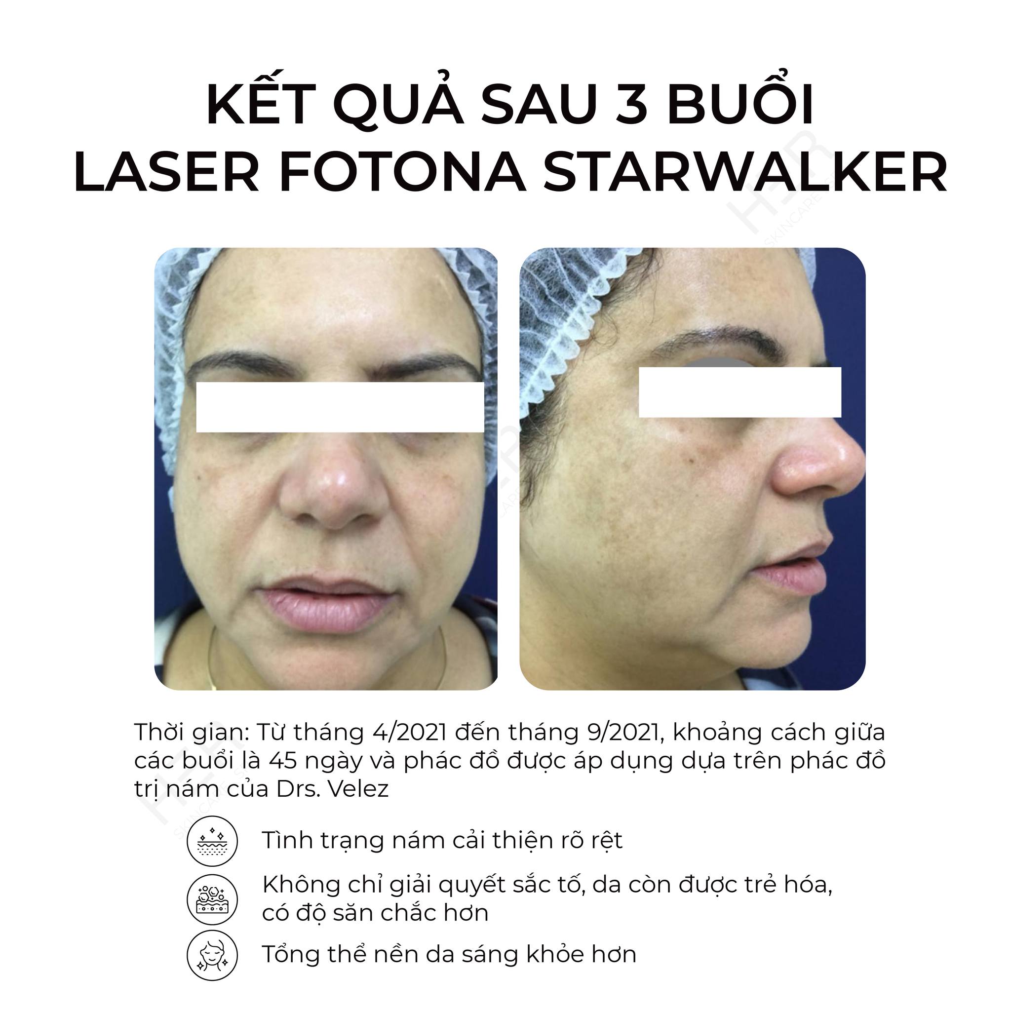 LASER-FOTONA-MO-RA-KY-NGUYEN-MOI-TRONG-DIEU-TRI-5.jpg