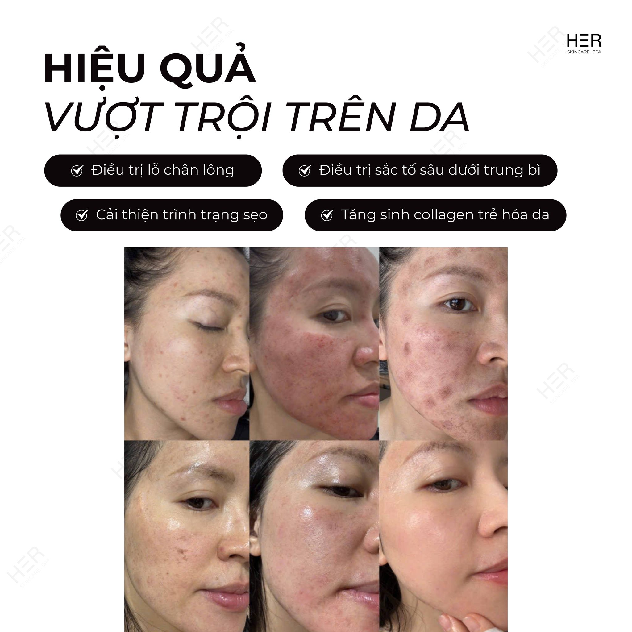 DEEP-SO-GLOW-DINH-CAO-CONG-NGHE-LASER-PICO-TAI-TAO-DA-DA-TANG-4.jpg