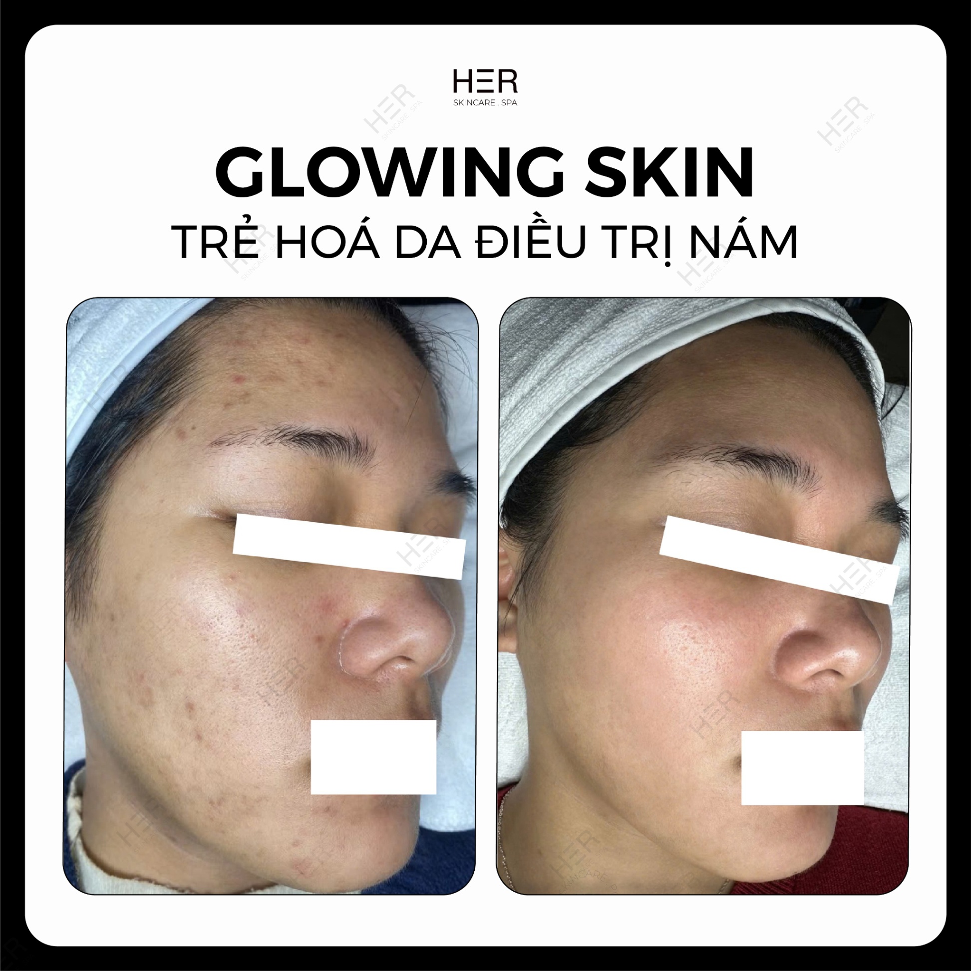 Glowing Skin - Trẻ hoá da điều trị nám