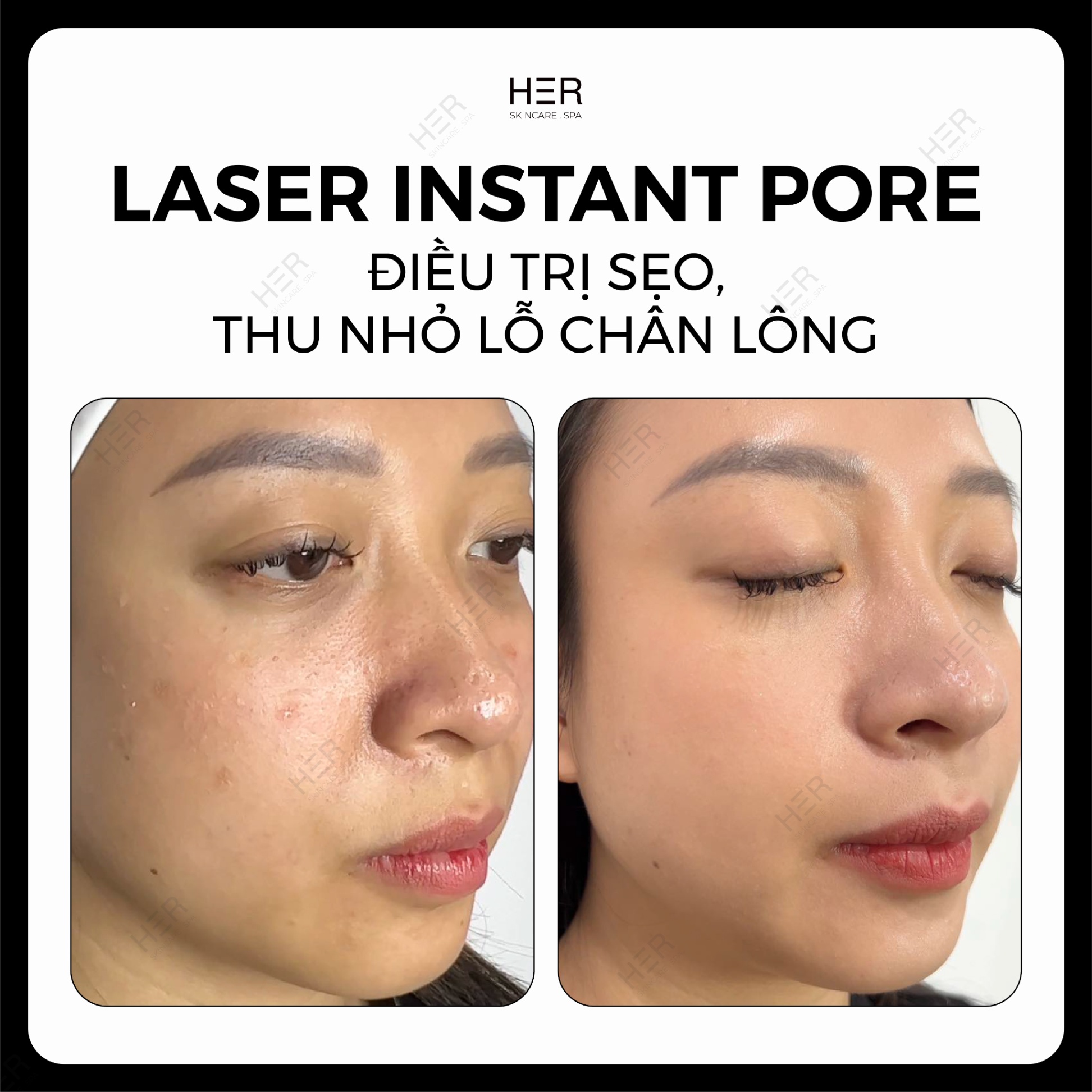 Laser Instant Pore - Điều trị sẹo, thu nhỏ lỗ chân lông
