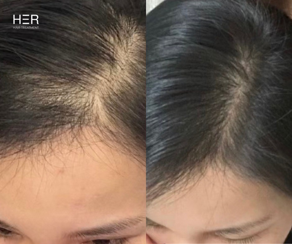 Fotona’s HaiRestart - Laser kích thích mọc tóc