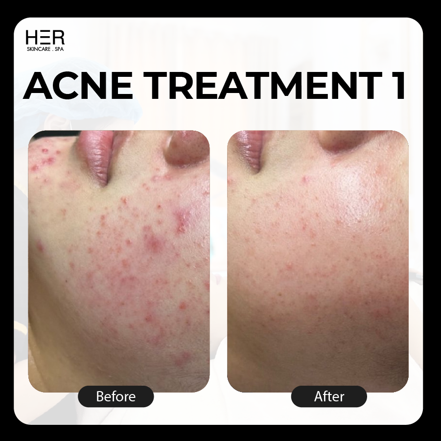 Acne Treatment Level 1 - Sự kết hợp giữa làm sạch chuyên sâu với công nghệ IPL giảm tăng sắc tố