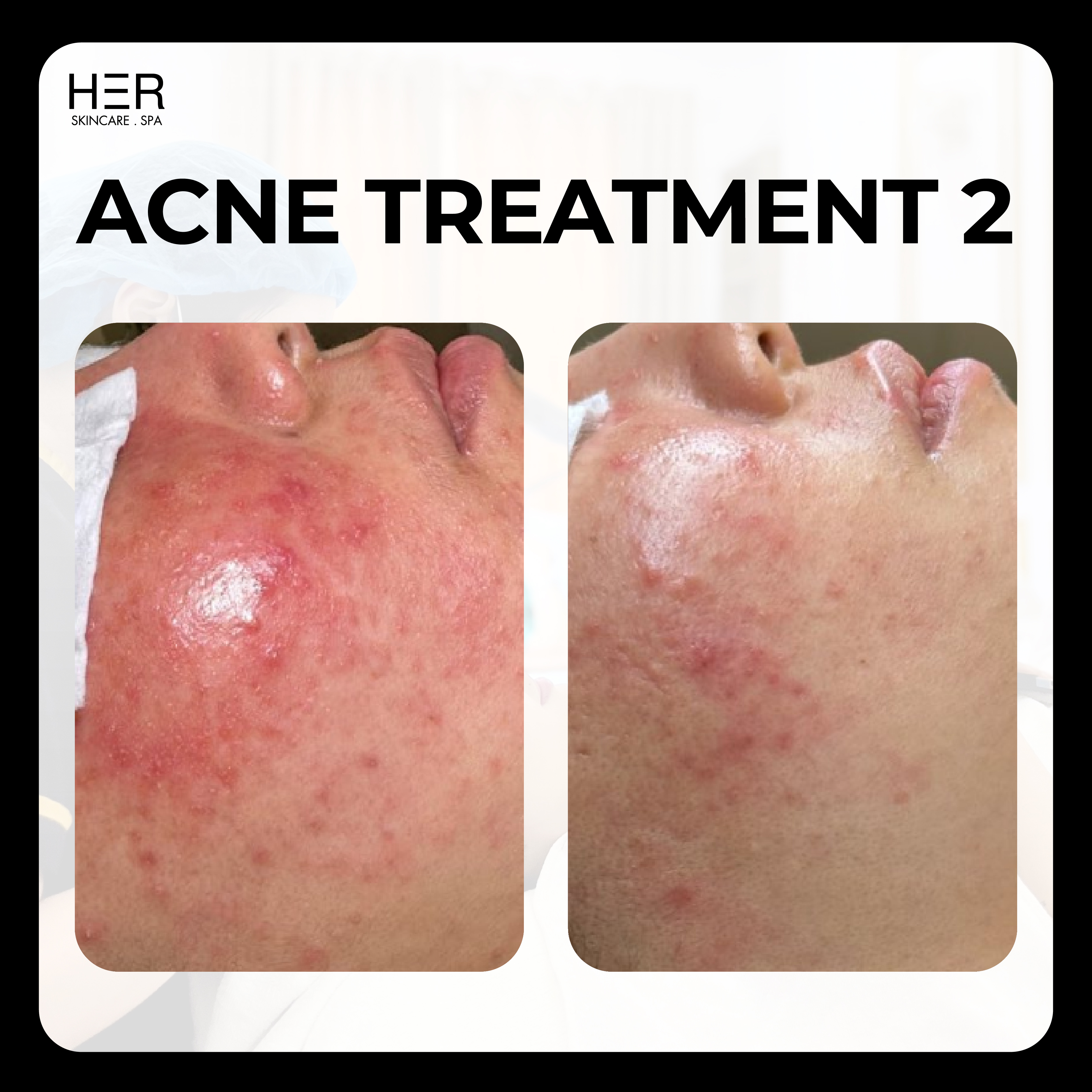Acne Treatment Level 2 - Sự kết hợp giữa công nghệ Cryo Derm và LED Therapy làm giảm nhanh chóng tình trạng viêm, thâm mụn