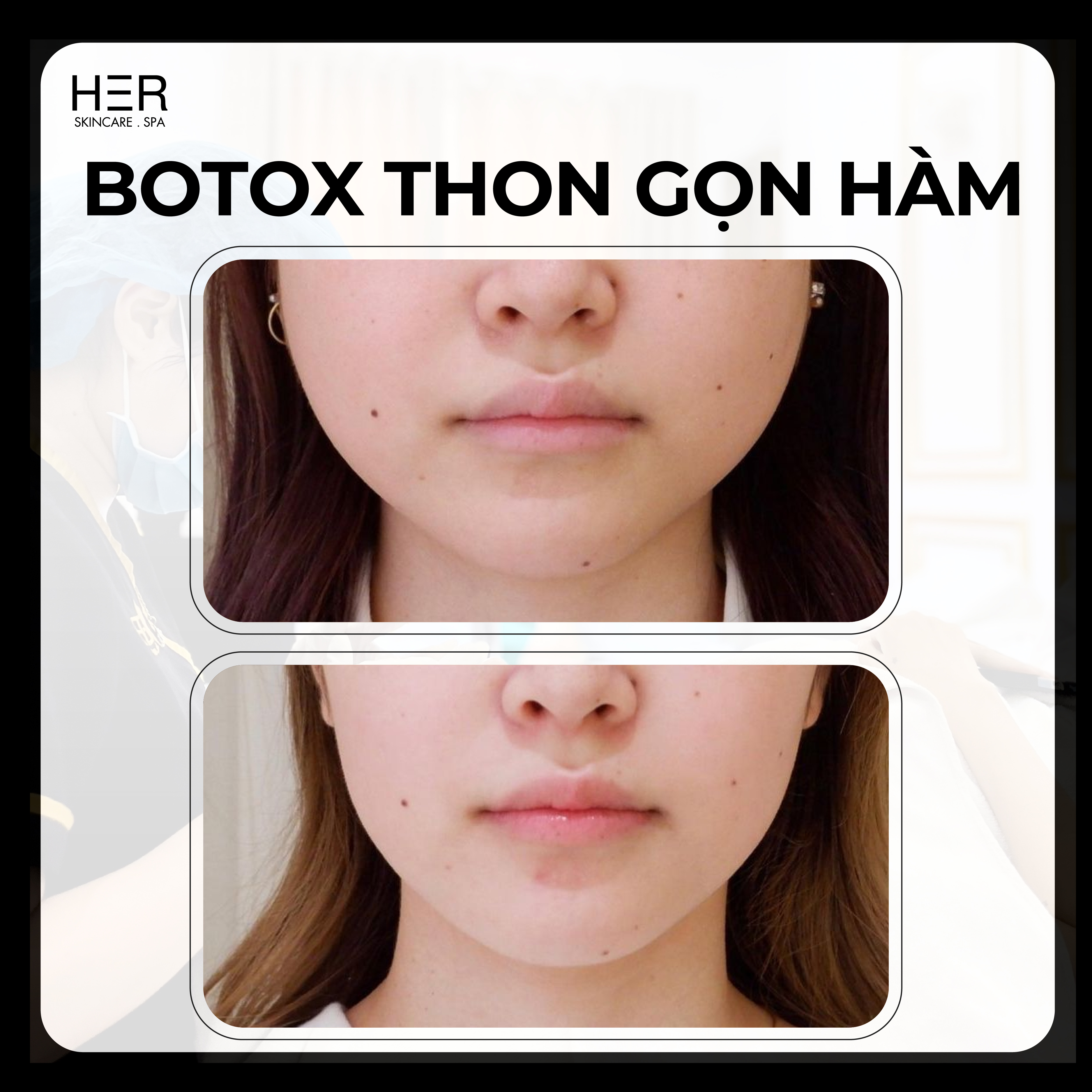 BOTOX Thon gọn hàm USA