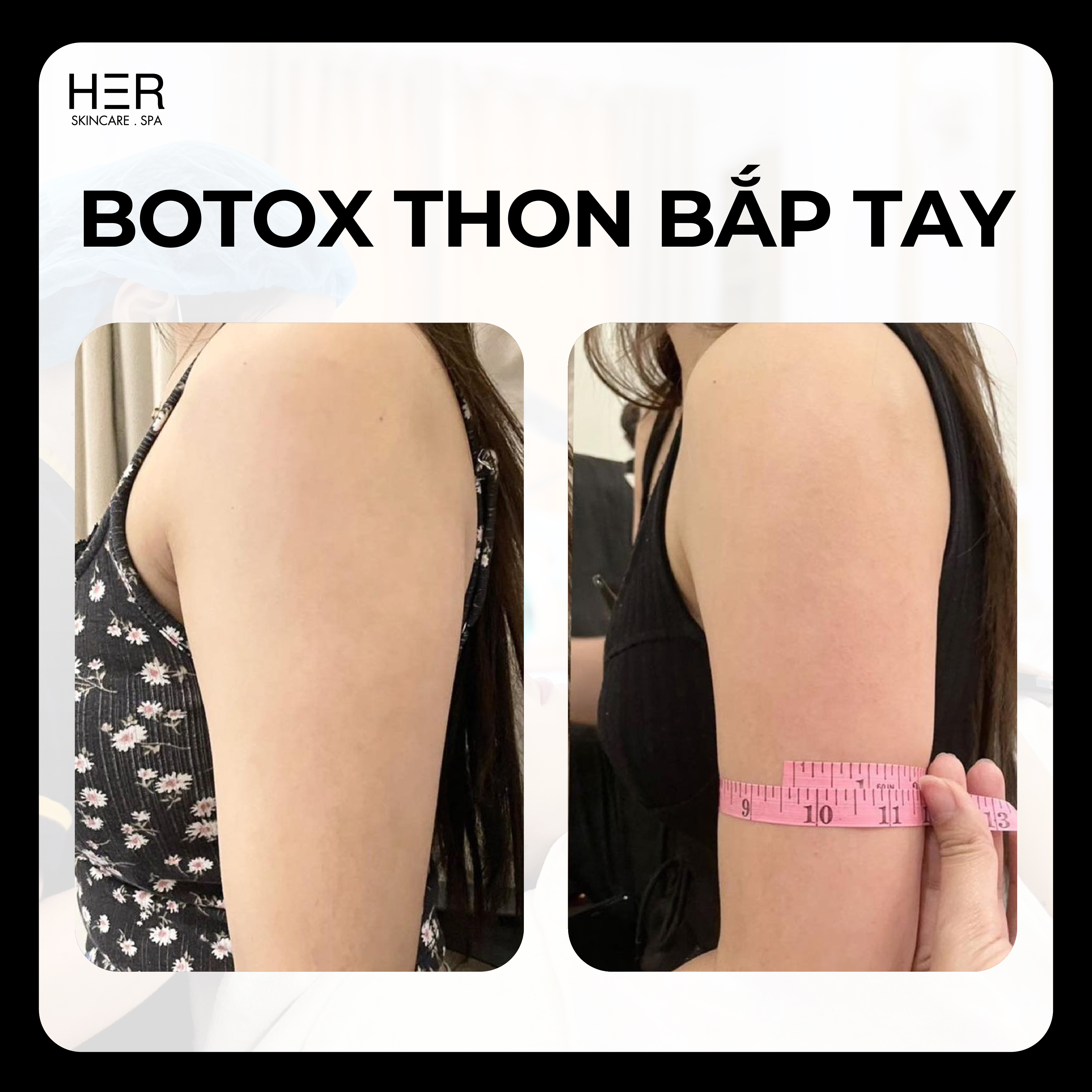 BOTOX - Tiêm thon gọn cơ bắp tay