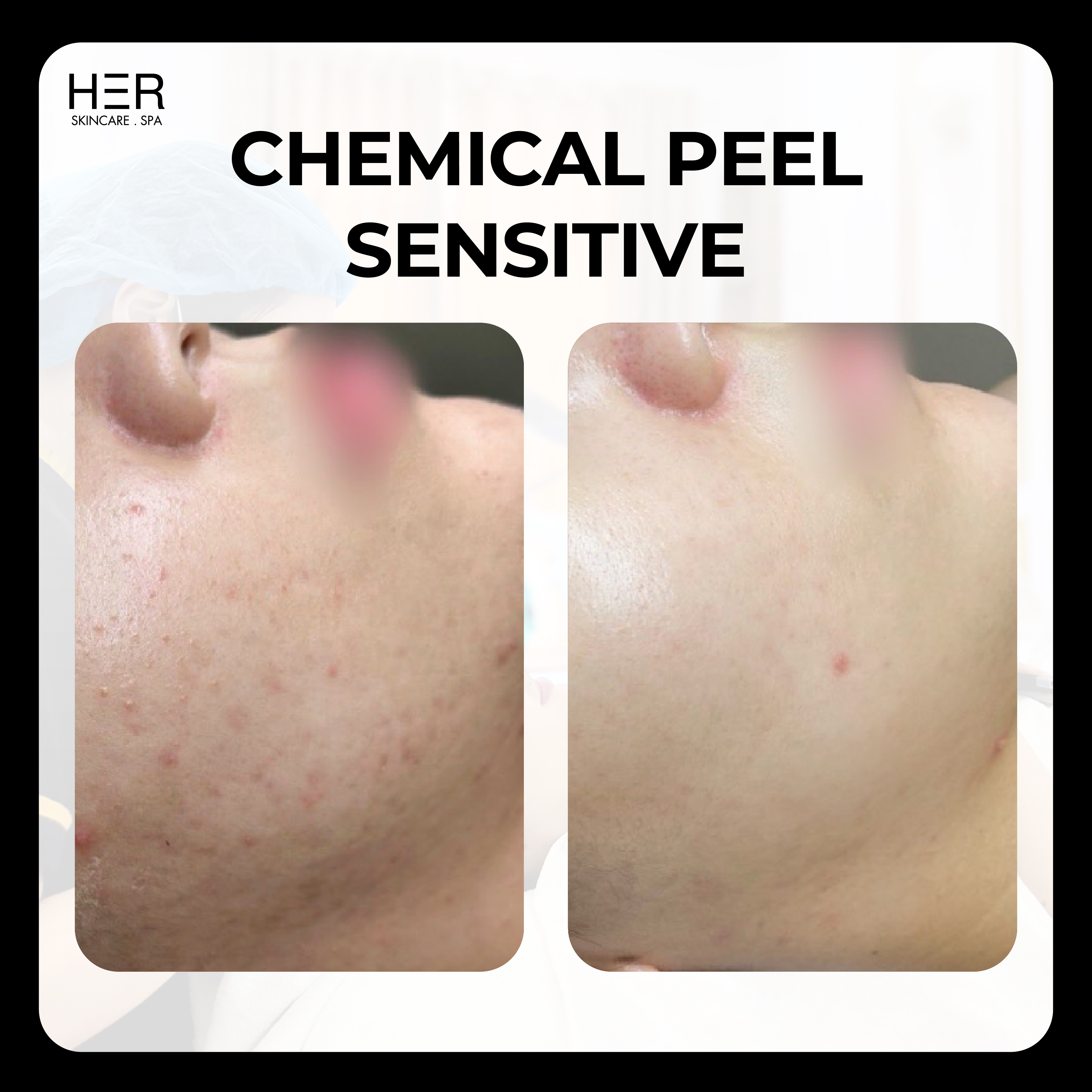 Chemical Peel Sensitive - Peel điều trị mụn cho da mẫn cảm