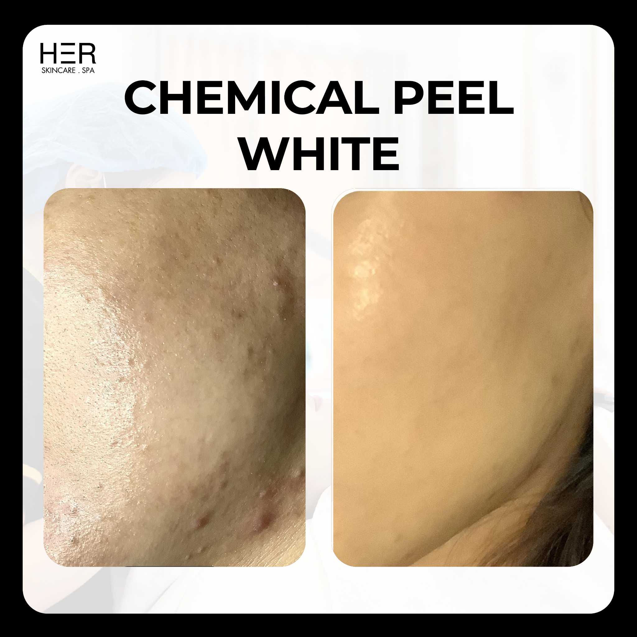 Chemical Peel White: Peel làm sáng, mờ thâm
