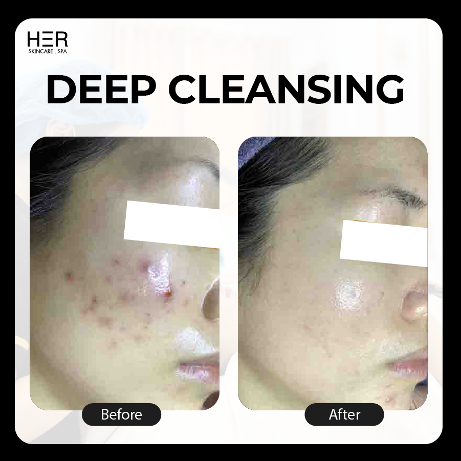 Deep Cleansing - Làm sạch và lấy nhân mụn chuyên sâu