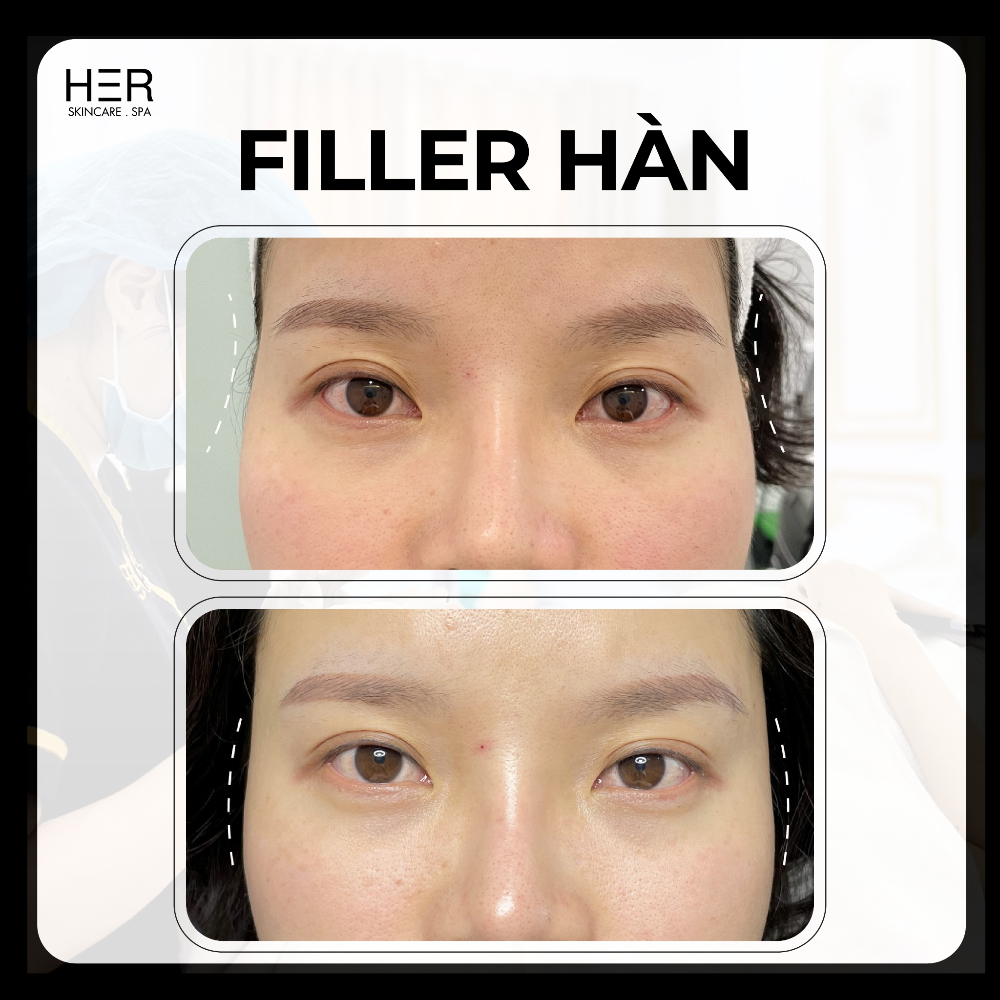 Filler Vip Hàn Quốc