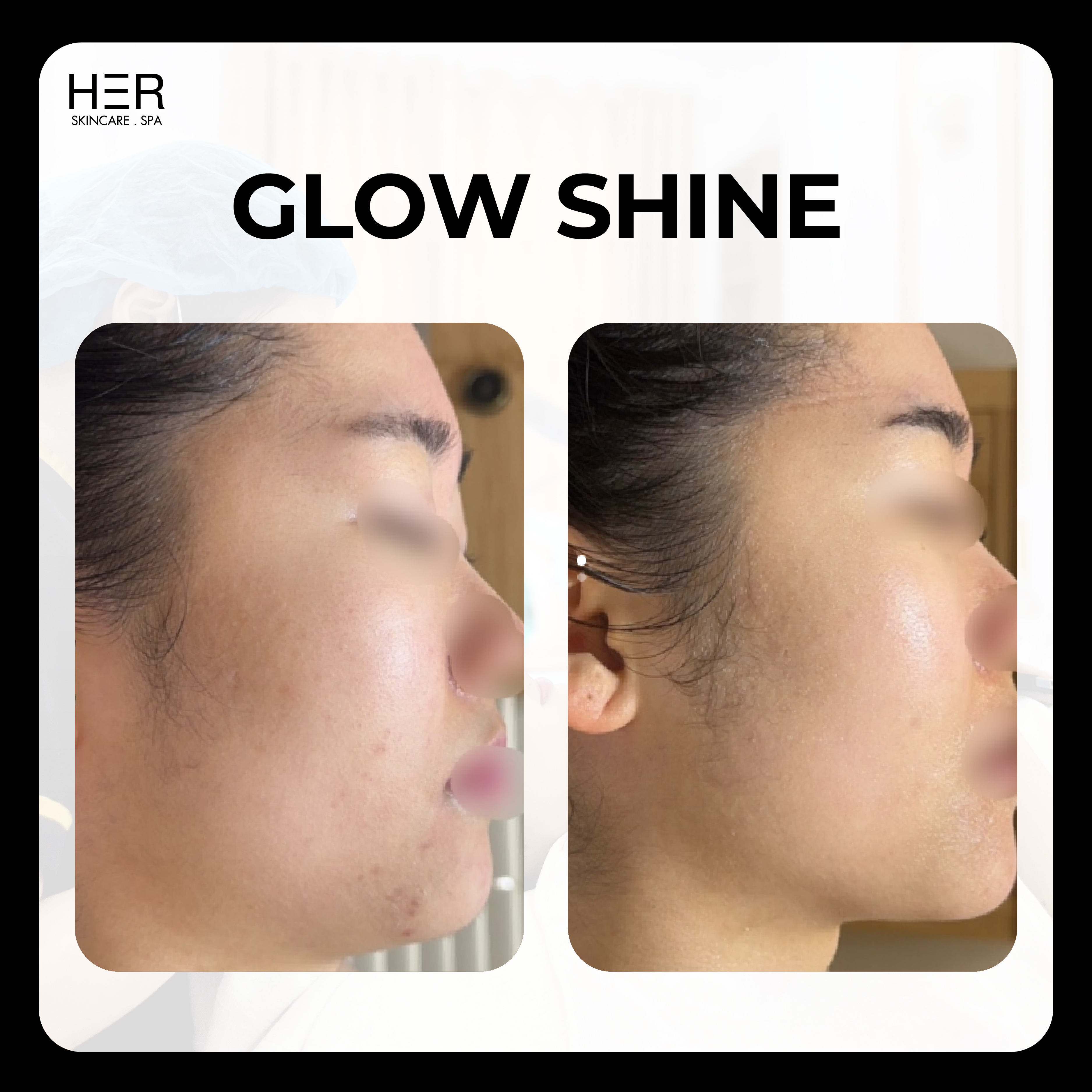 Glow Shine - Căng bóng, trẻ hoá da