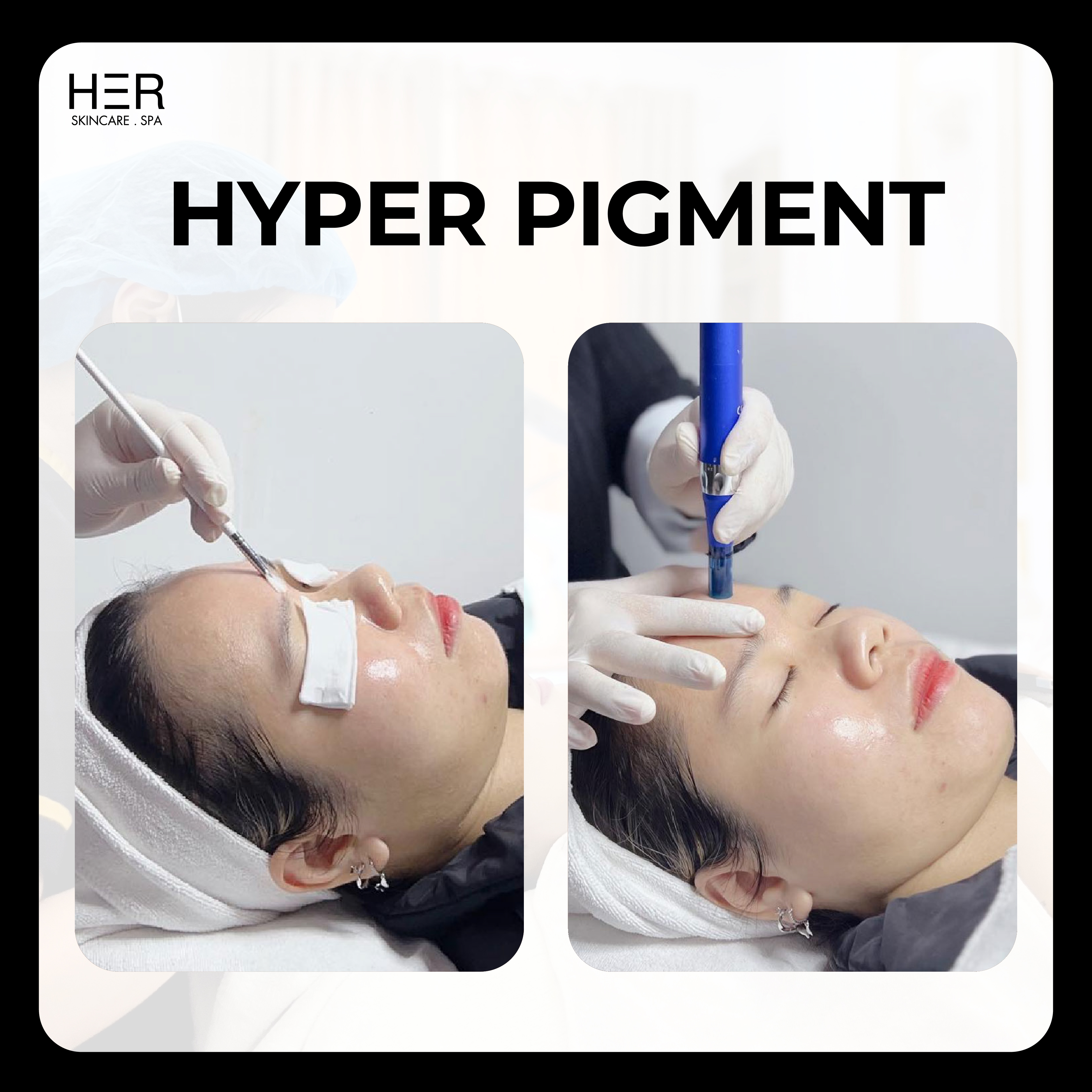 HYPER PIGMENT - Căng bóng, trẻ hoá da