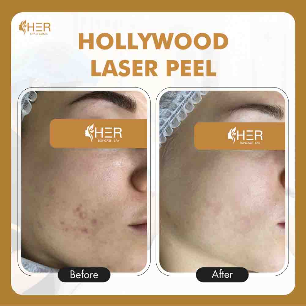 Hollywood Laser - Trẻ hoá & điều trị mụn