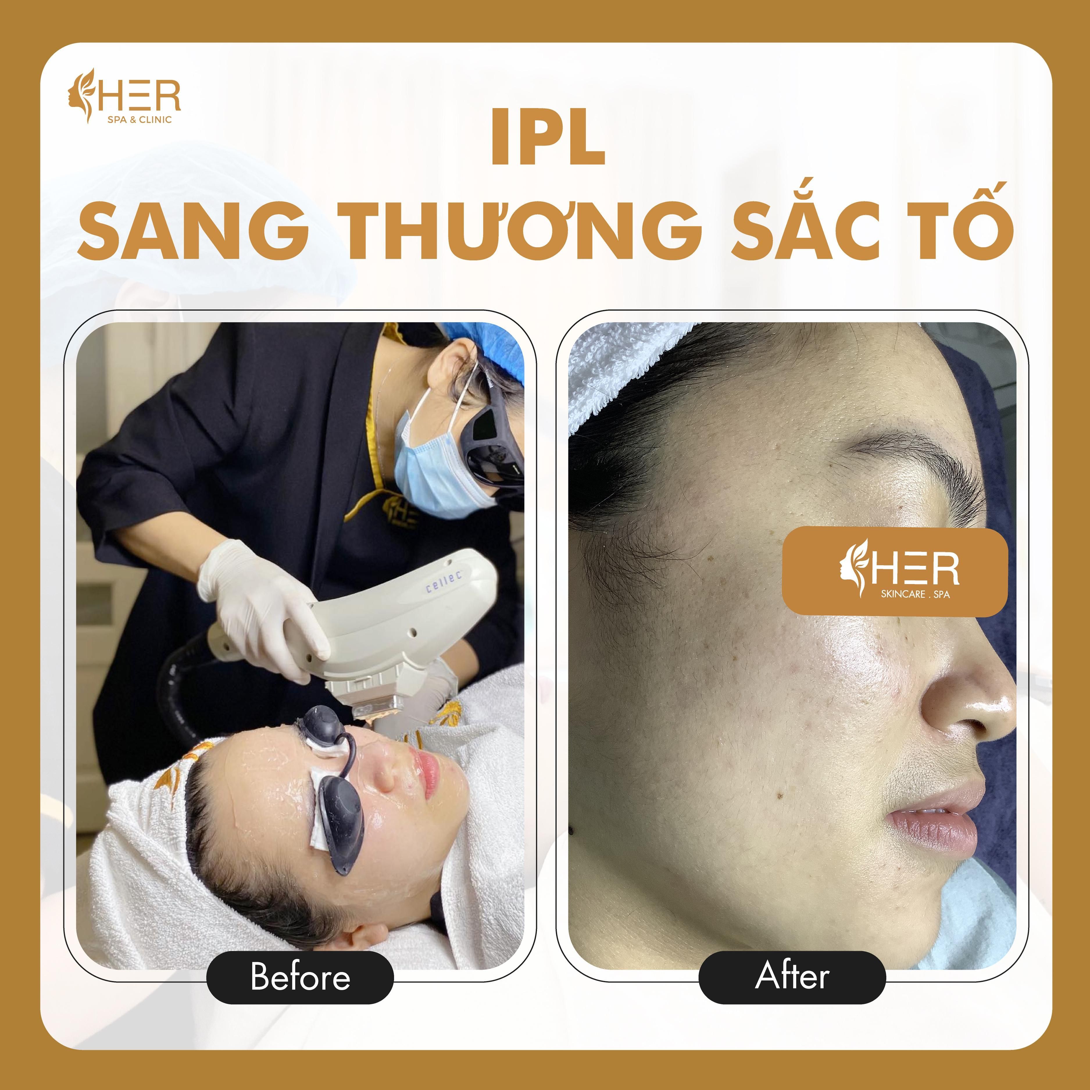 IPL - Công Nghệ Điều Trị Sang Thương Sắc Tố, Nâng Cơ, Trẻ Hoá