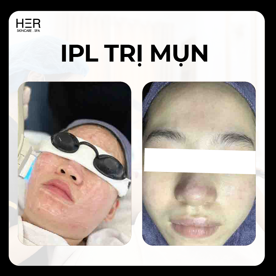 IPL - Công nghệ Điều Trị Mụn, Giảm Viêm