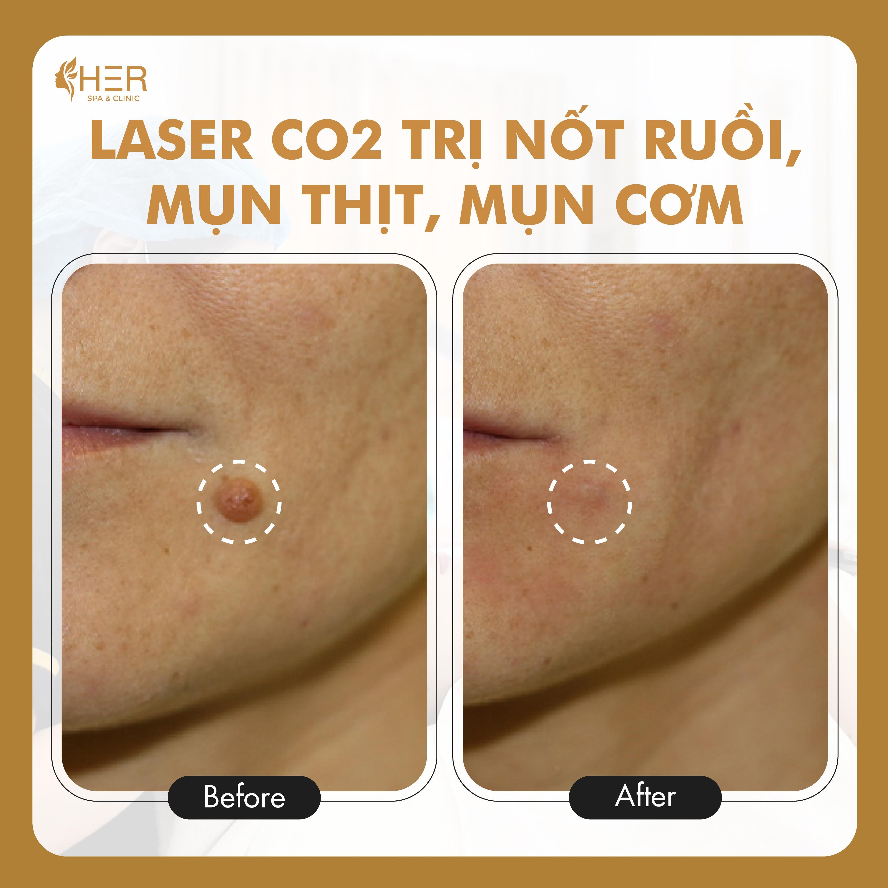 Laser CO2 Điều trị Nốt Ruồi, Mụn Thịt, Mụn Cơm (Giá theo số lượng thực tế)