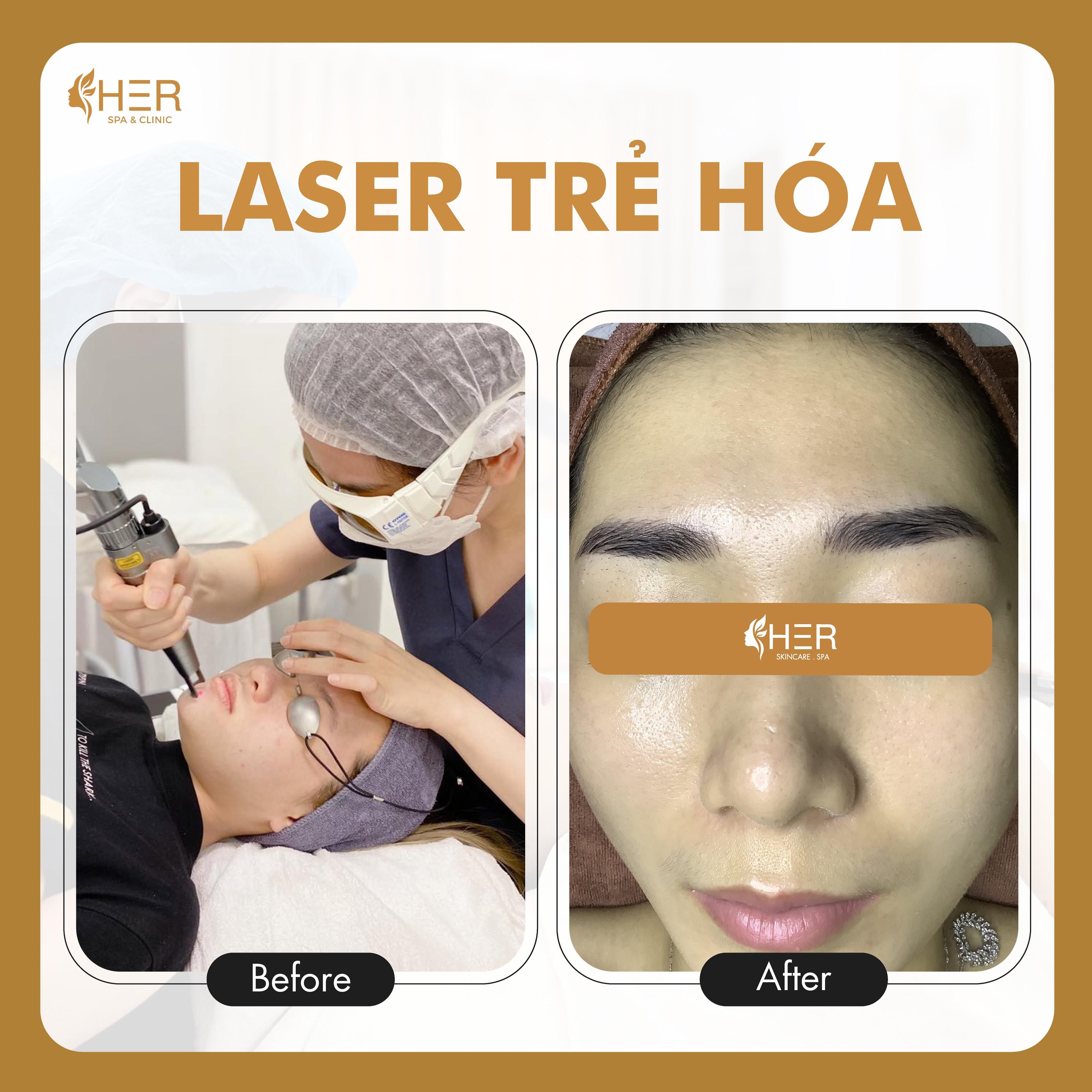 Laser Trẻ Hóa Da & Điều trị sẹo CO2 Fractional