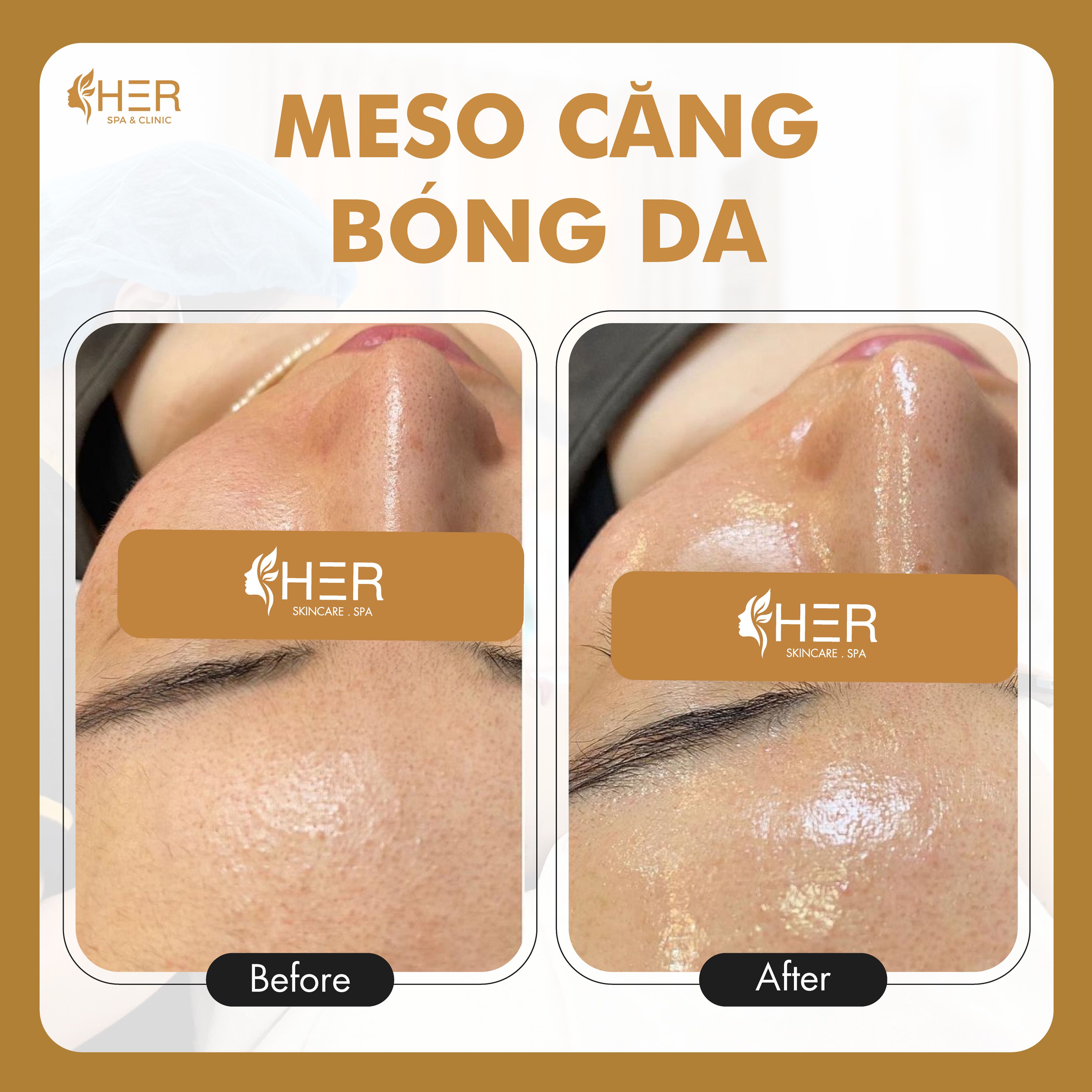 Meso Glow - Mesotherapy cấp nước căng bóng, tăng cường cấu trúc da