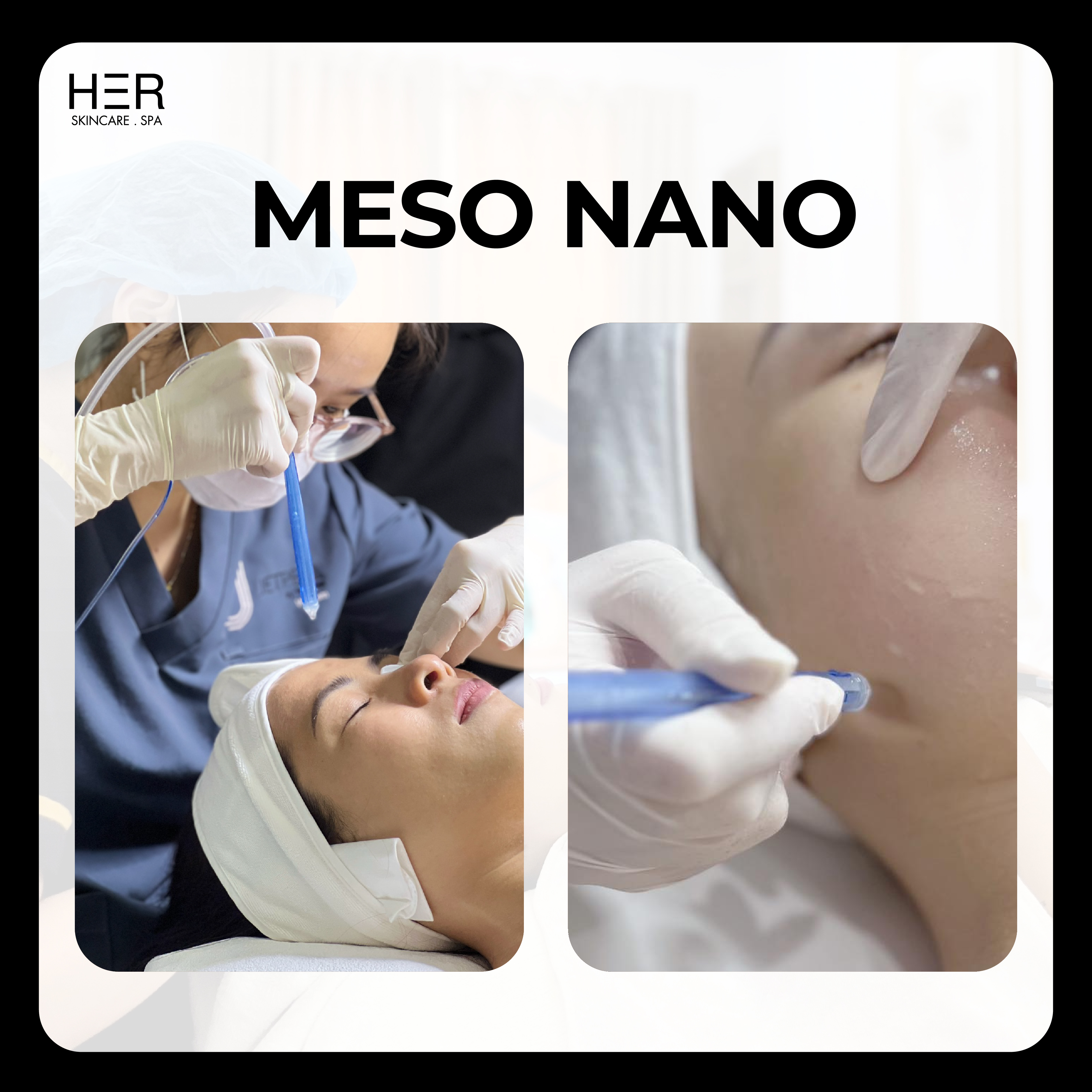 Meso Nano - Căng bóng da không kim