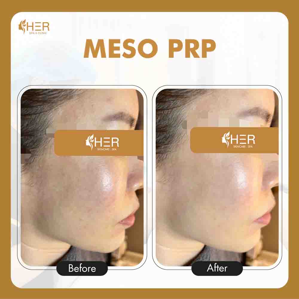 Meso PRP - Mesotherapy với phương pháp tách máu tự thân giúp táo tạo và khôi phục những da suy giảm cấu trúc