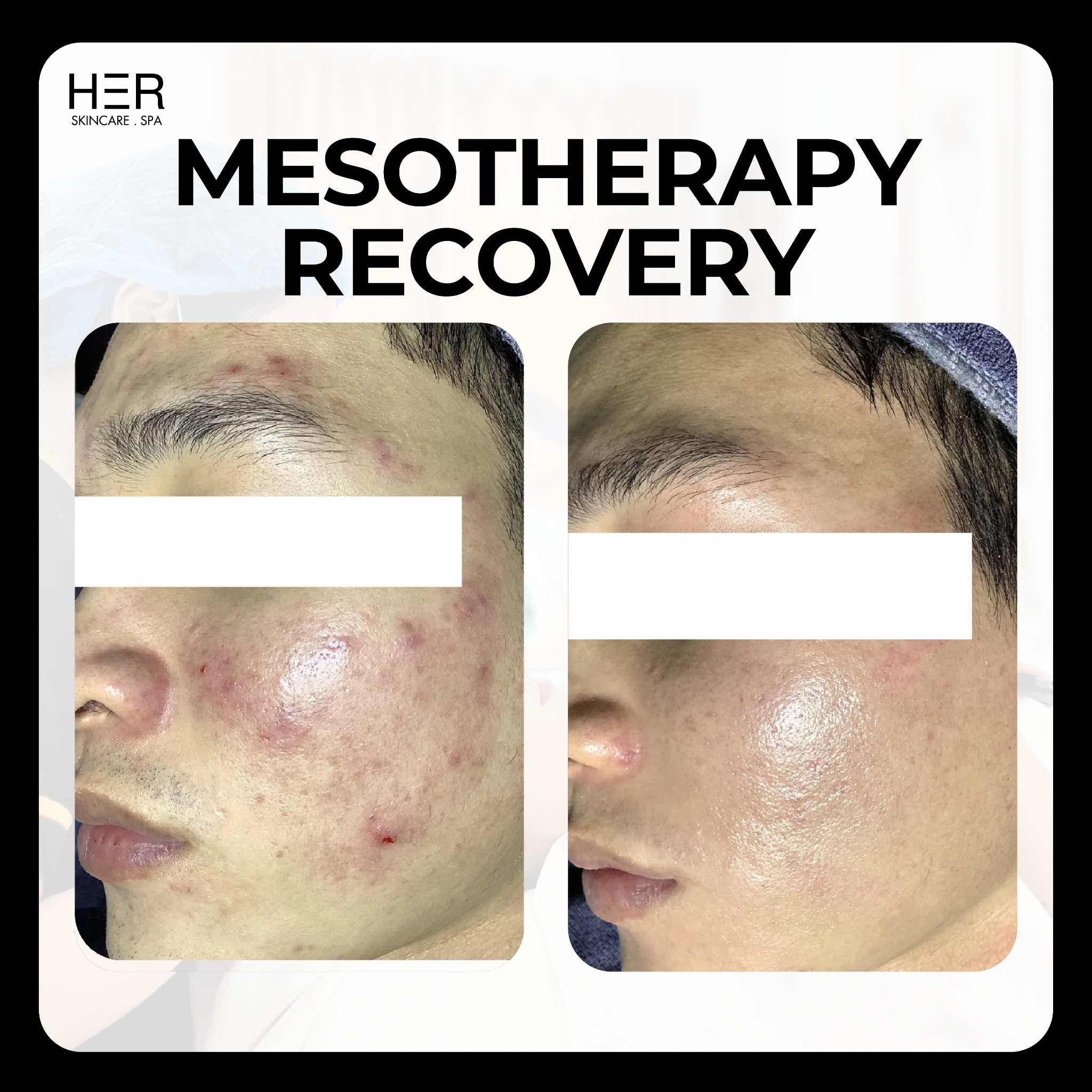 Meso Recovery - Mesotherapy phục hồi và nuôi dưỡng làn da mẫn cảm