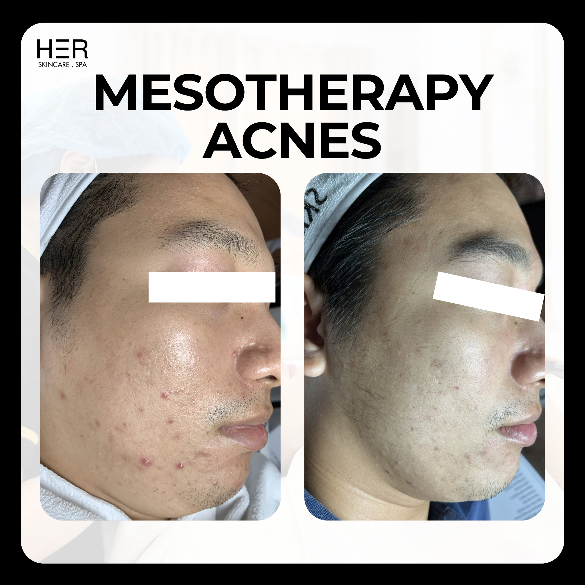 Mesotherapy Acnes - Mesotherapy điều trị cho da mụn