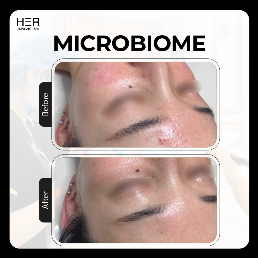 Microbiome Skin - Cân bằng hệ vi sinh