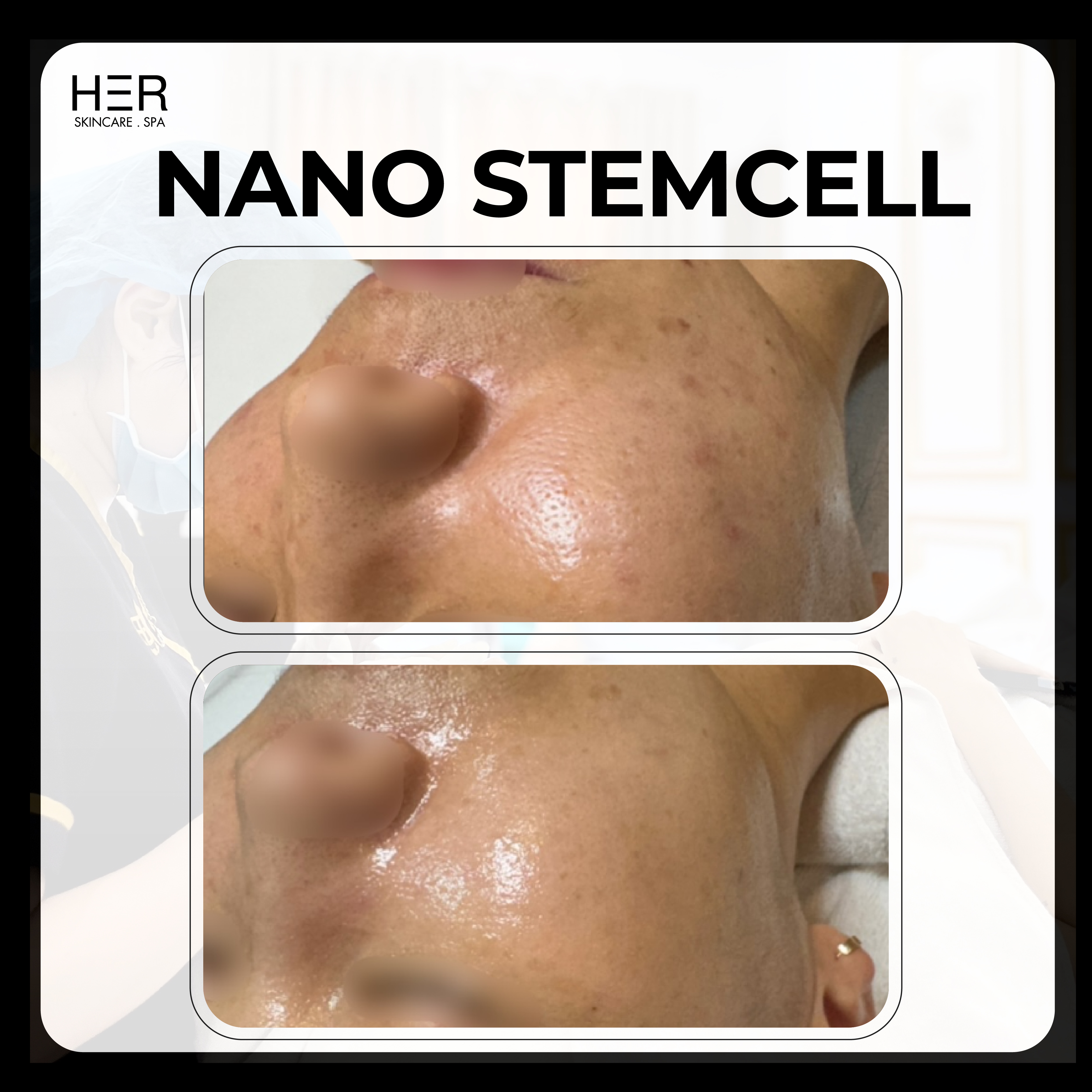 Nano Stemcell - Giảm thâm làm sáng