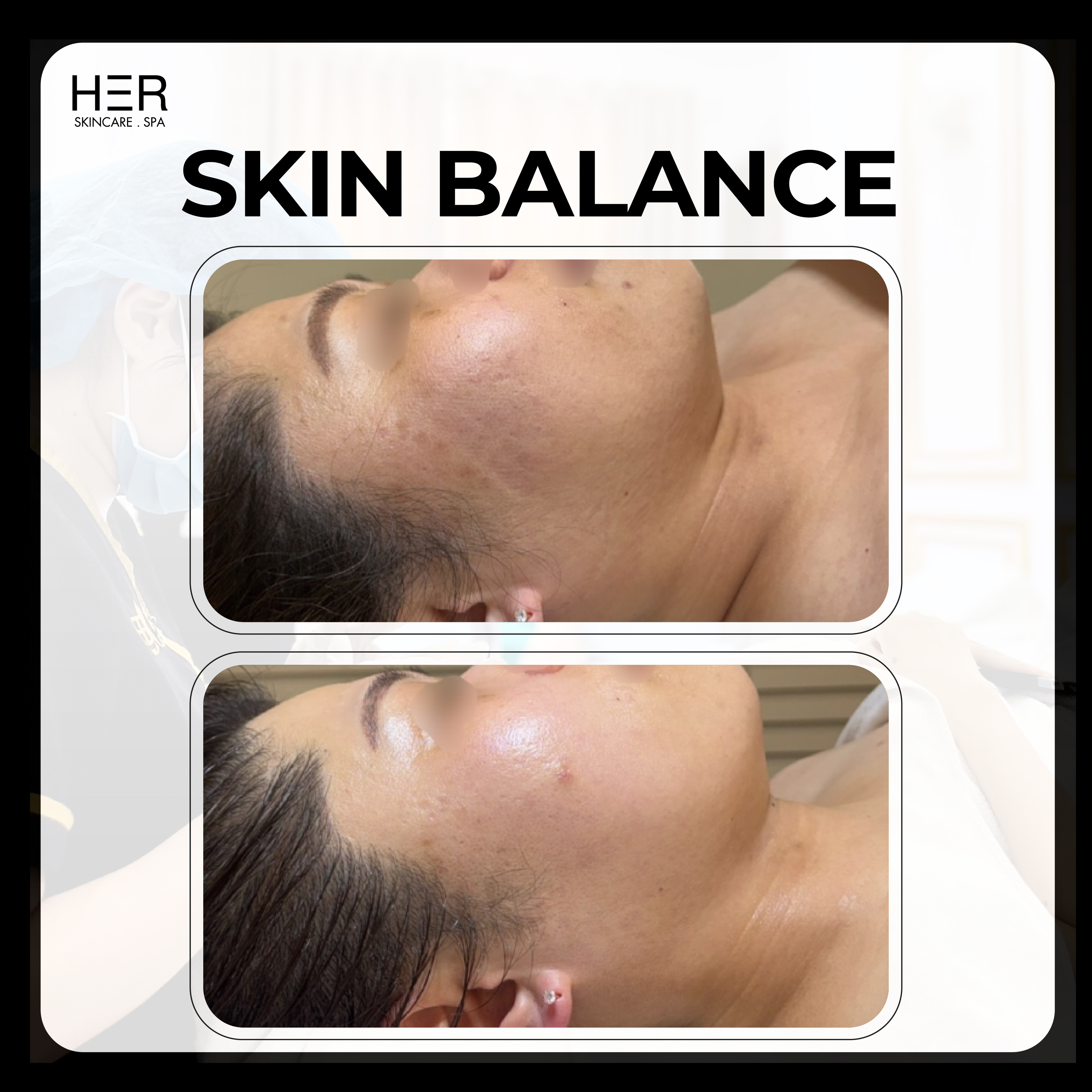 Skin Balance - Cân bằng lại hàng rào bảo vệ & Làm dịu da mẫn cảm