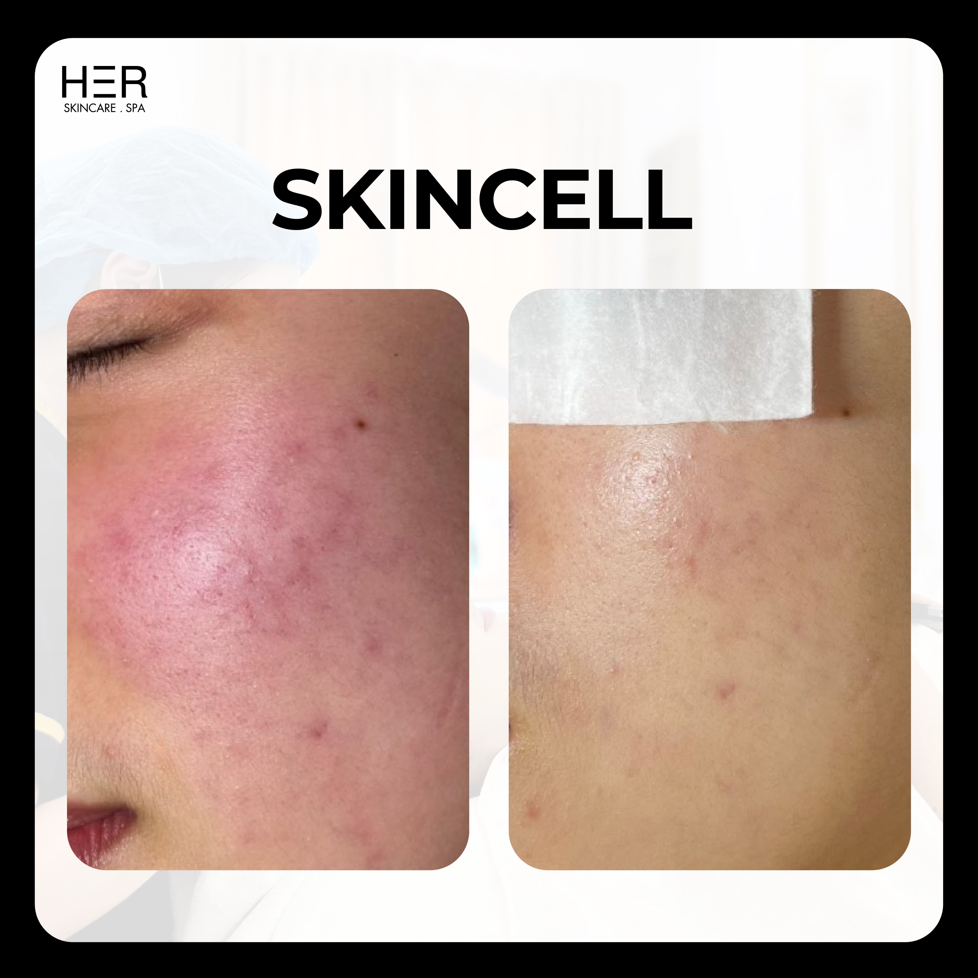 SkinCell - Kích hoạt tế bào tế bào & Khôi phục da