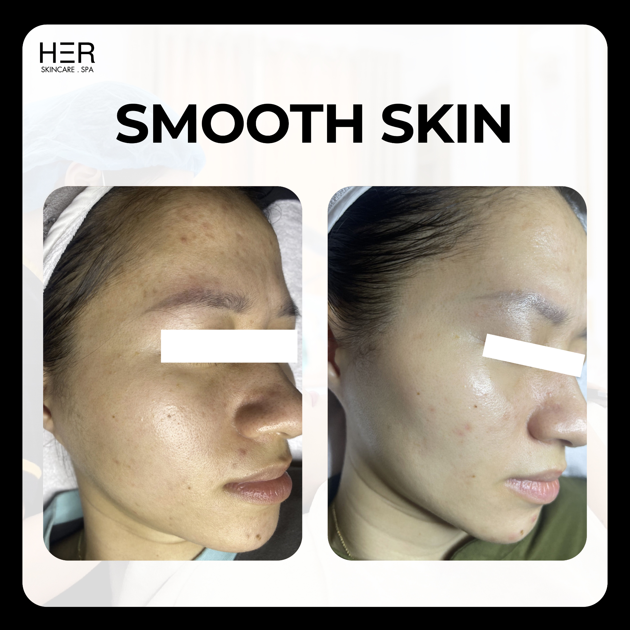 Smooth Skin by Fotona - Peel da căng bóng