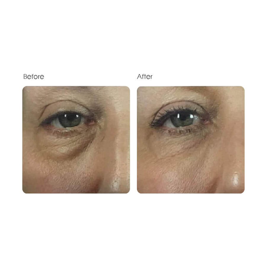 Md:Complex Eye Contour – Tiêm xóa quầng thâm & Túi mỡ mắt