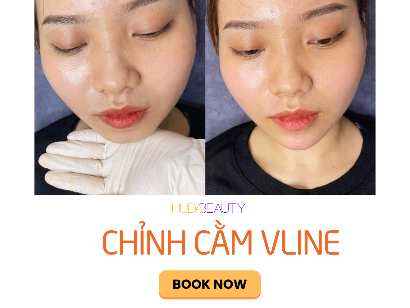 Chỉnh cằm Vline