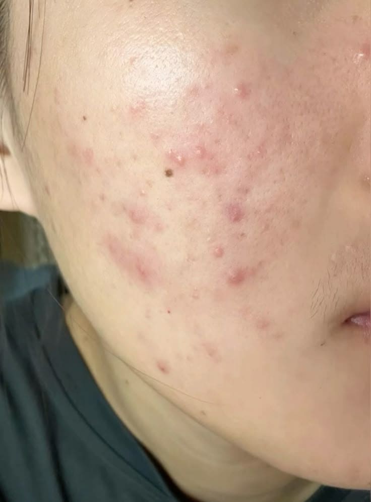 Bao-Lau-Nen-Lay-Nhan-Mun-Mot-Lan-_Lấy Nhân Mụn (1).jpg