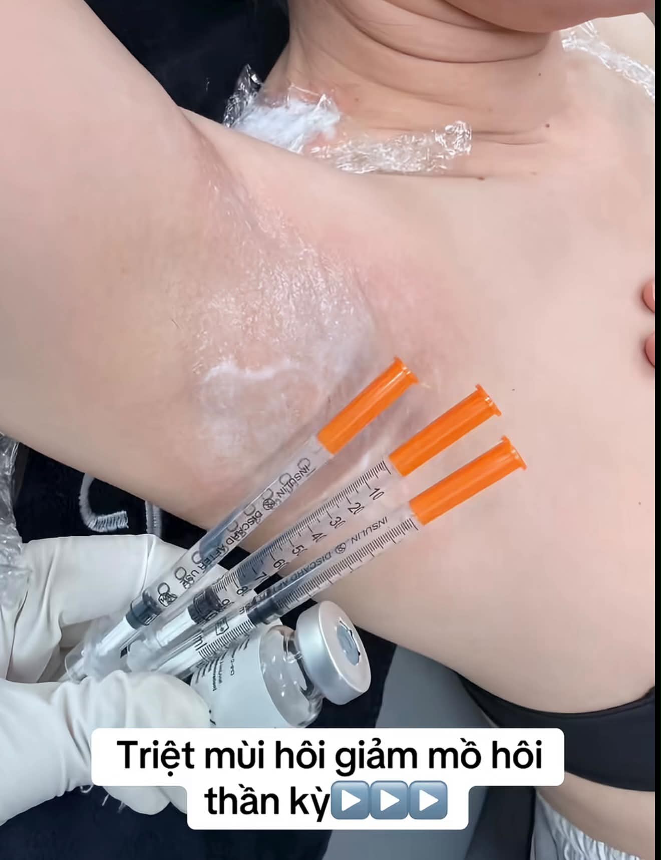 Botox trị tăng tiết mồ hôi có hiệu quả không?