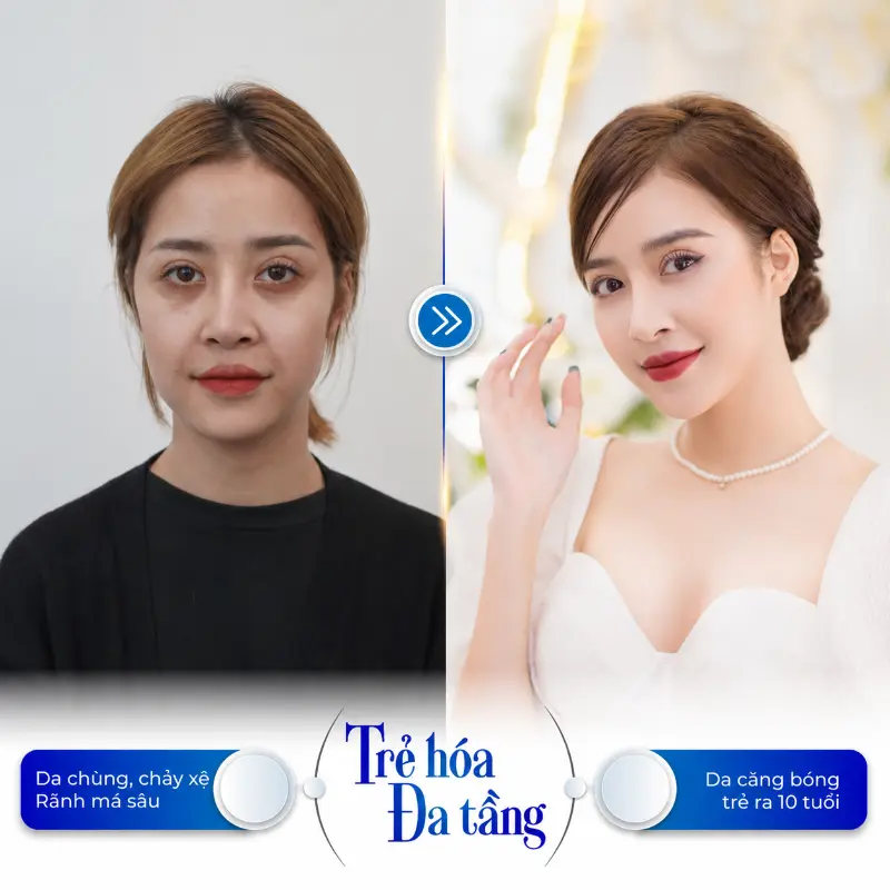 Căng Chỉ Có Làm Mặt Bị Lệch Không?