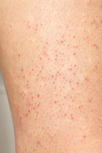 Cạo, Wax Lông Sai Cách – Nguyên Nhân Khiến Viêm Nang Lông Nặng Hơn