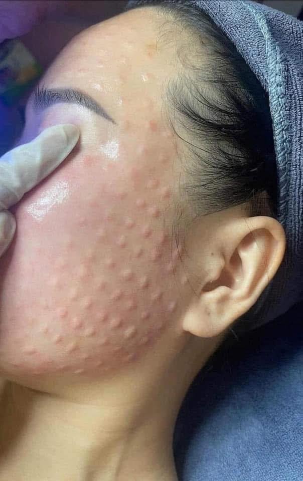 Da Bị Mụn Có Tiêm Mesotherapy Được Không?