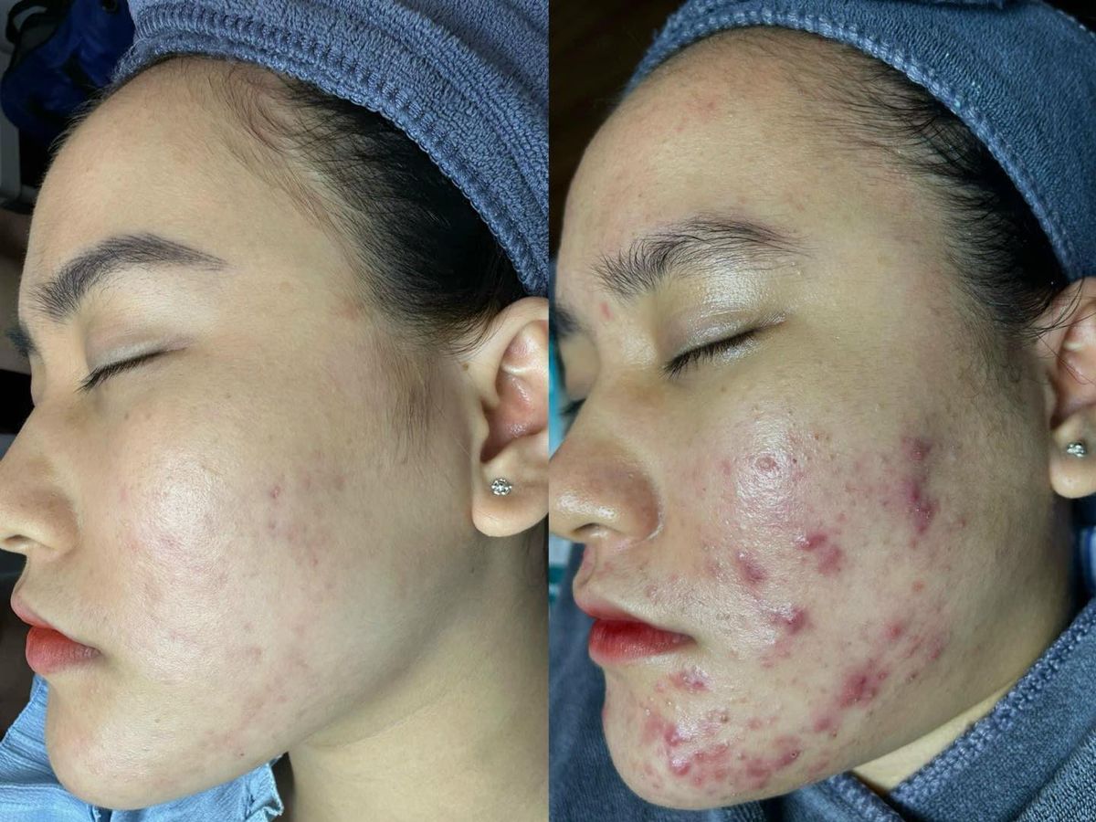 Điều Trị Mụn Bao Lâu Mới Thấy Hiệu Quả?