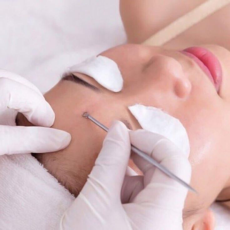 Lấy Nhân Mụn Có Làm Lỗ Chân Lông To Hơn Không?