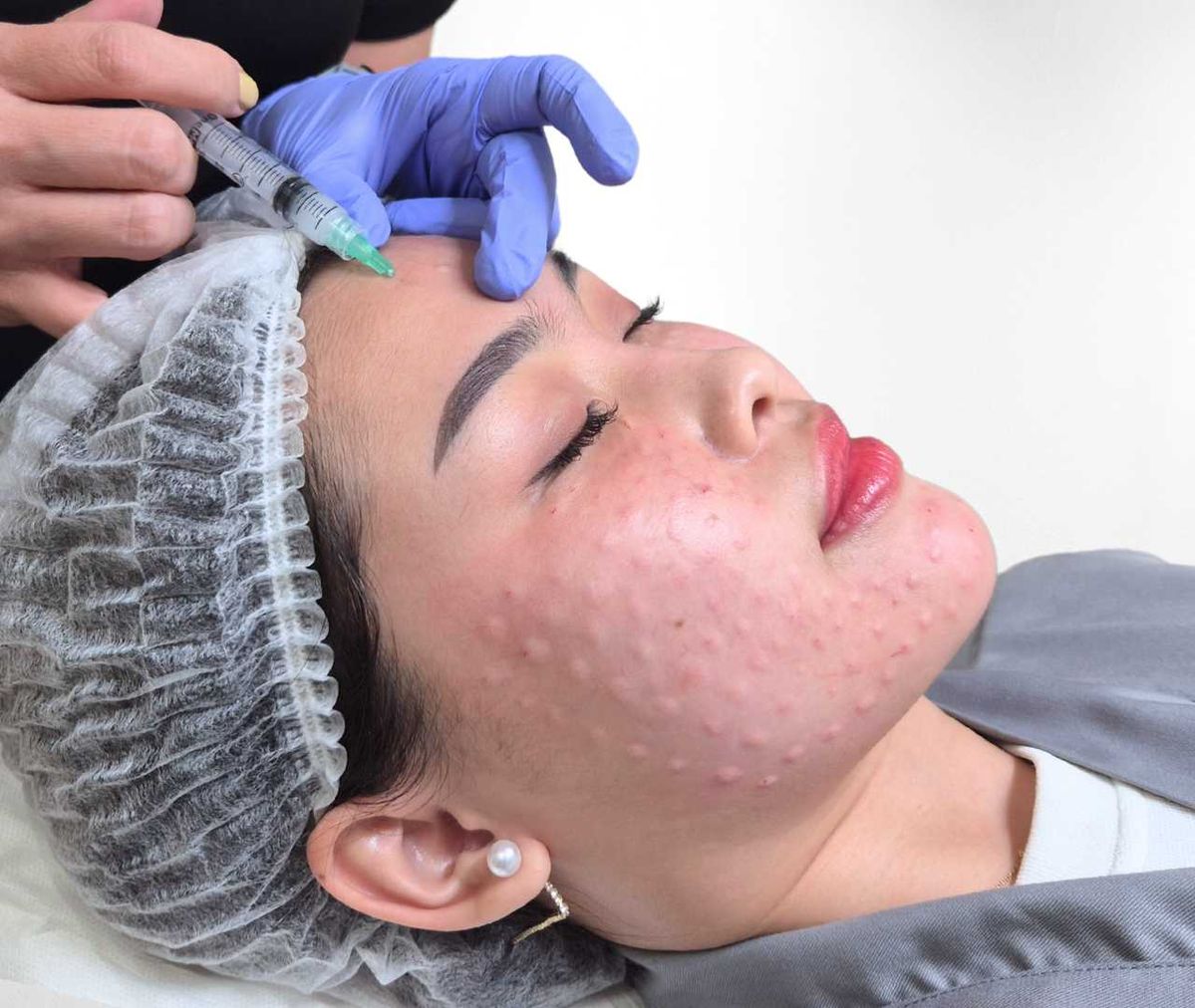 Meso Trị Mụn Có Hiệu Quả Với Mụn Nội Tiết Không?