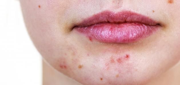 Mun-Cam-Li-Lap-Di-Lap-Lai-Vi-Sao-Mai-Khong-Het-_Mụn Cằm Lì, Lặp Đi Lặp Lại 1.jpg